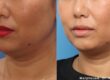 Morpheus8 The Non-surgical Face Lift