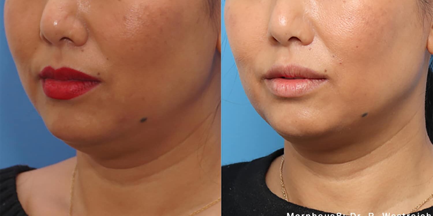 Morpheus8_BeforeAfter-16 Morpheus8 Treatment in Brighton CO