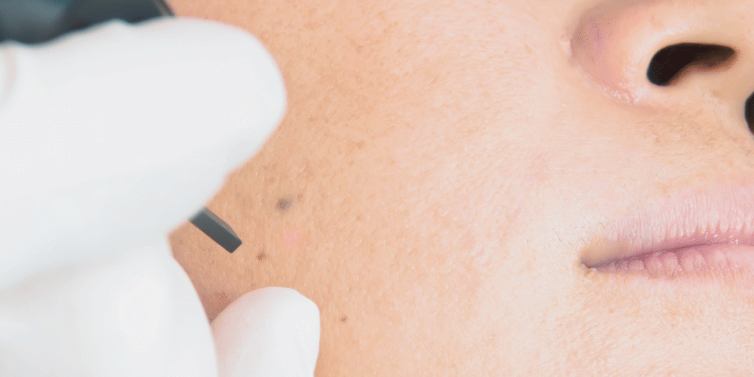 Morpheus8 Treatment in Brighton CO