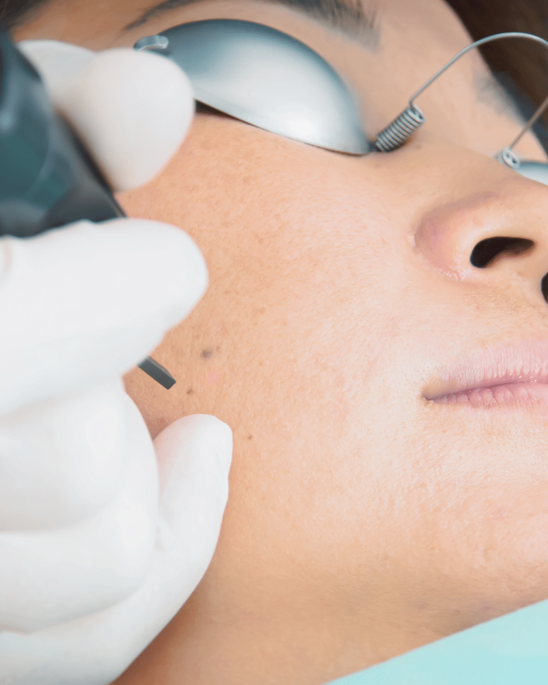 Morpheus8 Treatment in Brighton CO